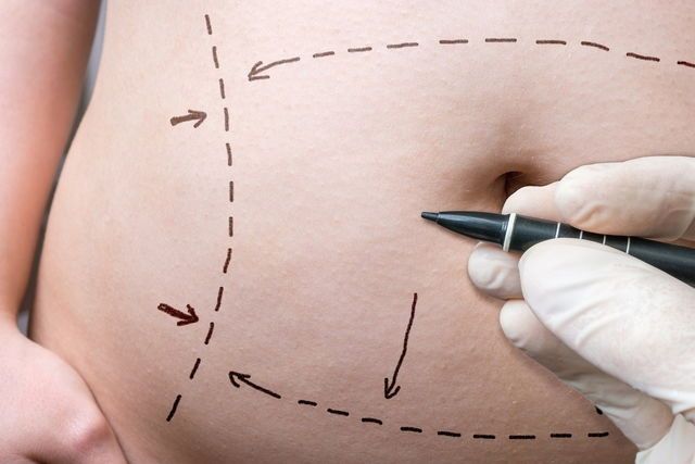 Abdominoplastia en Innova Cirugías Ambato