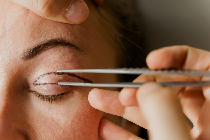 Blefaroplastia (Cirugía de Párpados) en Innova Cirugías Ambato