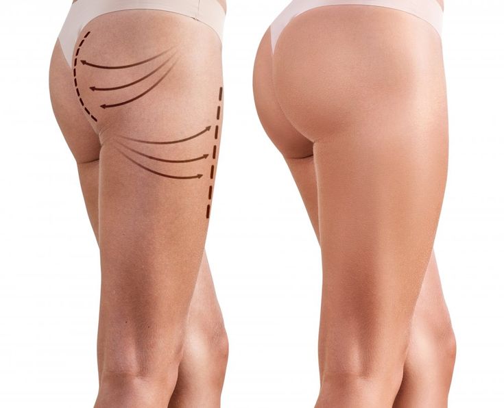 Body Lift (Lifting Corporal Circunferencial) en Innova Cirugías Ambato