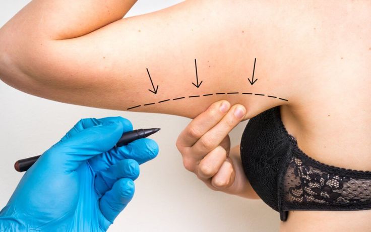 Braquioplastia (Lifting de Brazos) en Innova Cirugías Ambato