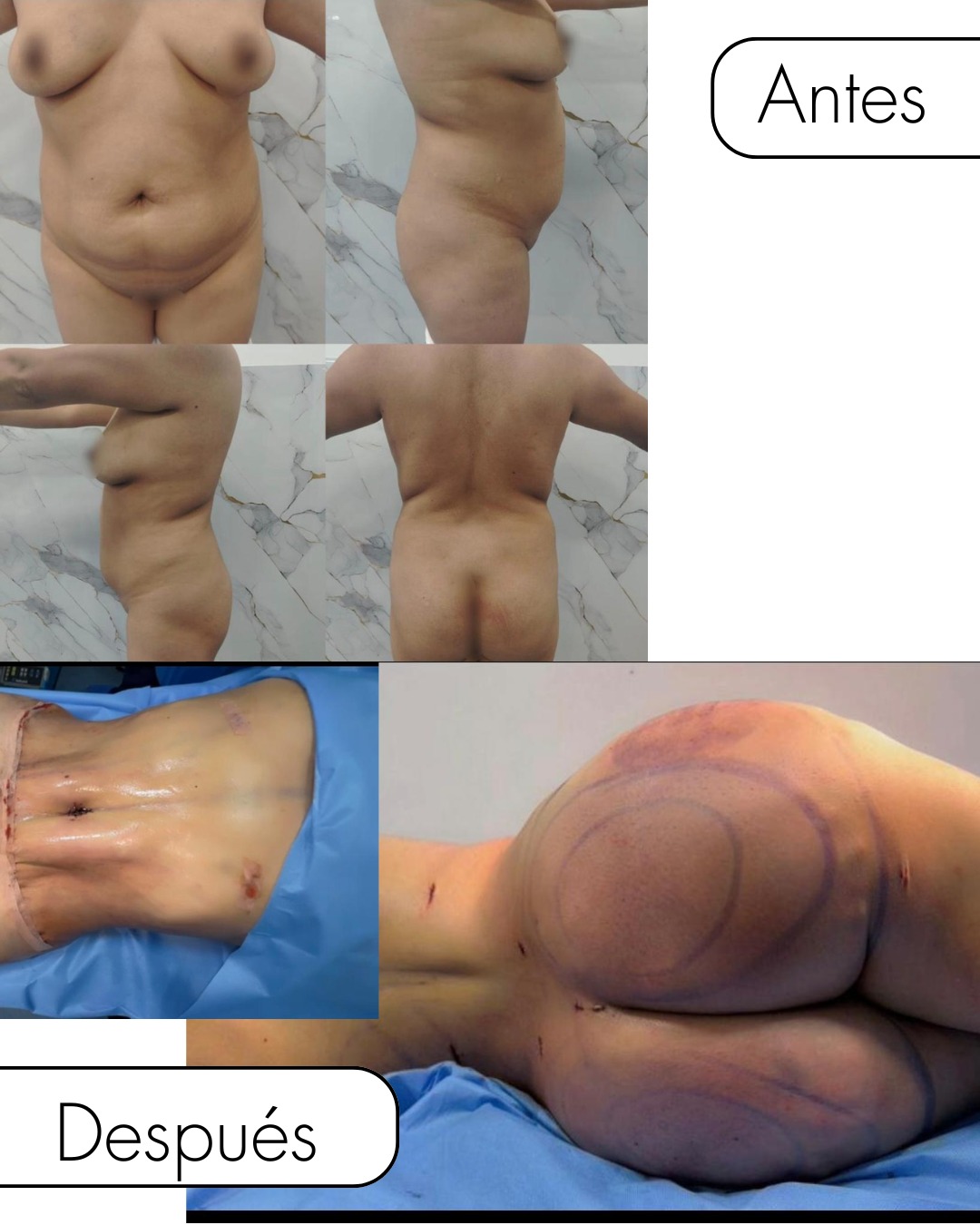 Dermolipectomía en Innova Cirugías Ambato