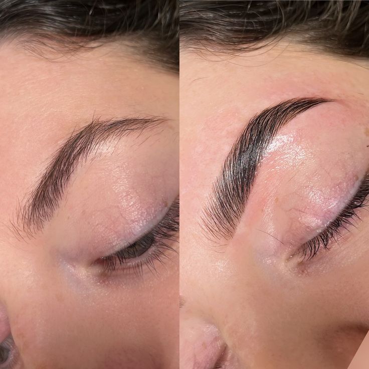 Lifting de Cejas (Frontoplastia) en Innova Cirugías Ambato