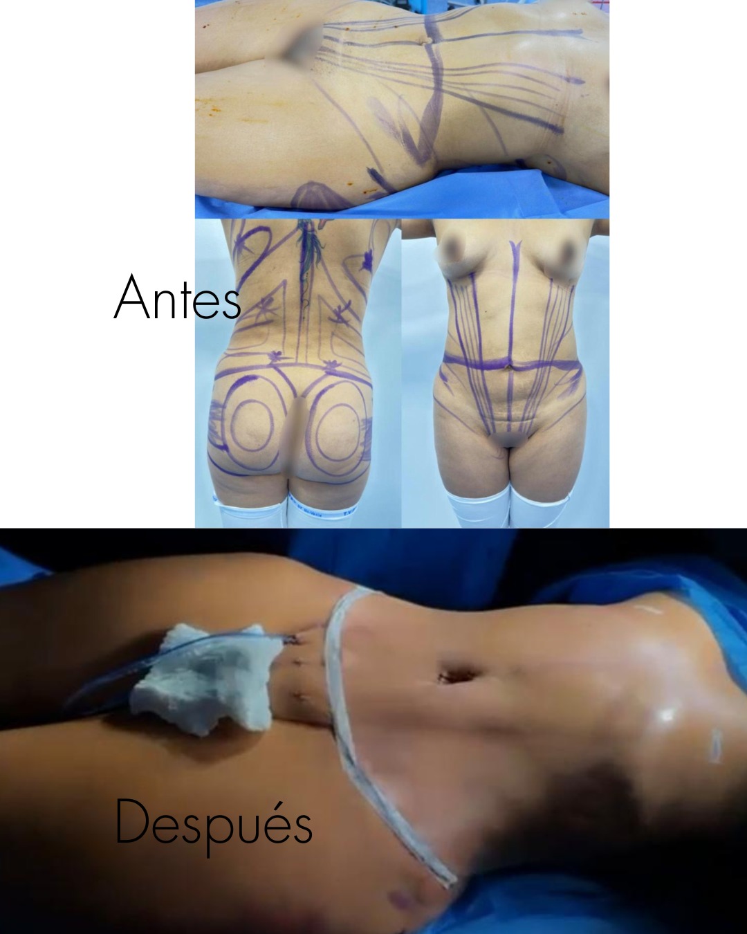 Lipoabdominoplastia en Innova Cirugías Ambato