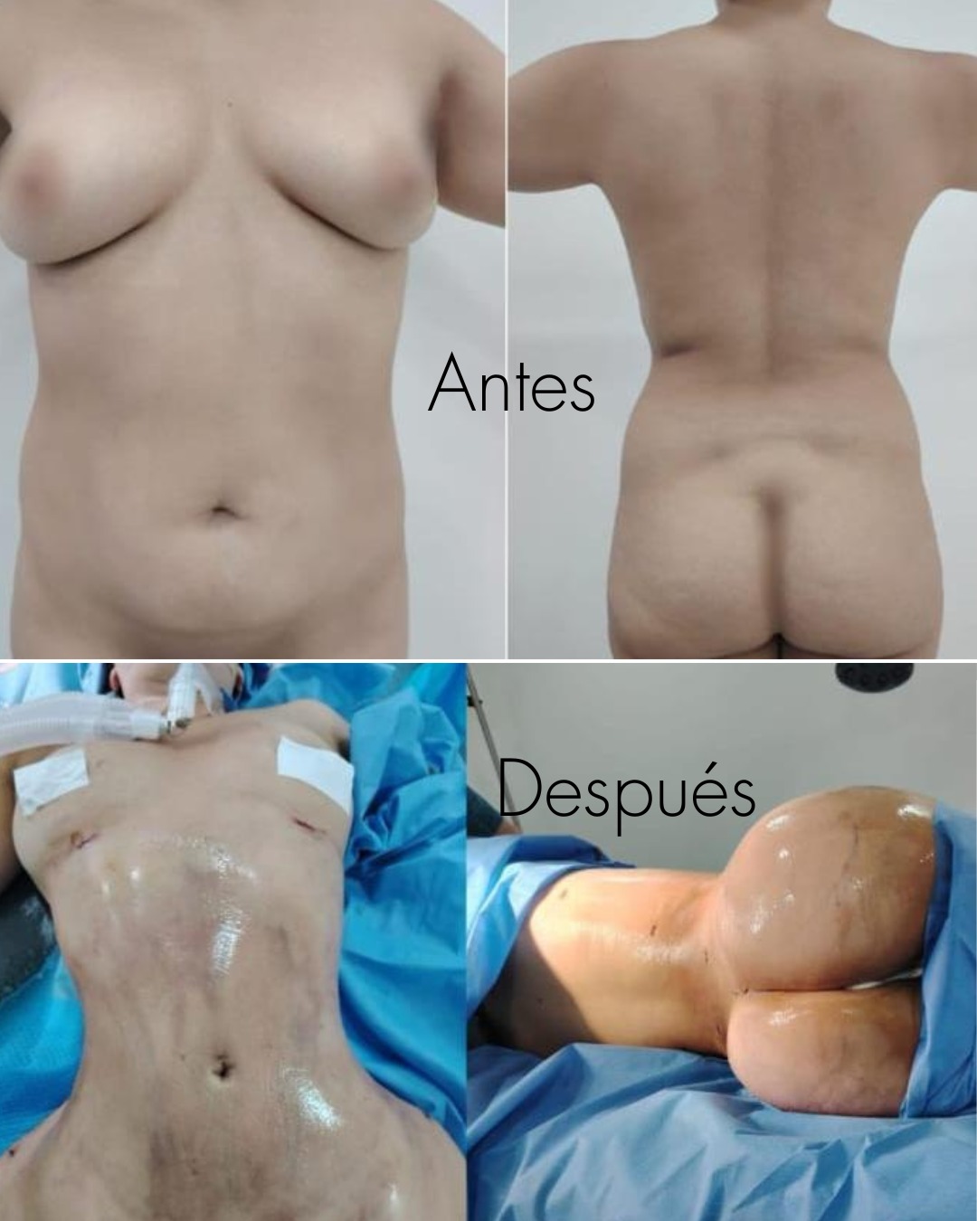 Lipoescultura de Alta Definición en Innova Cirugías Ambato