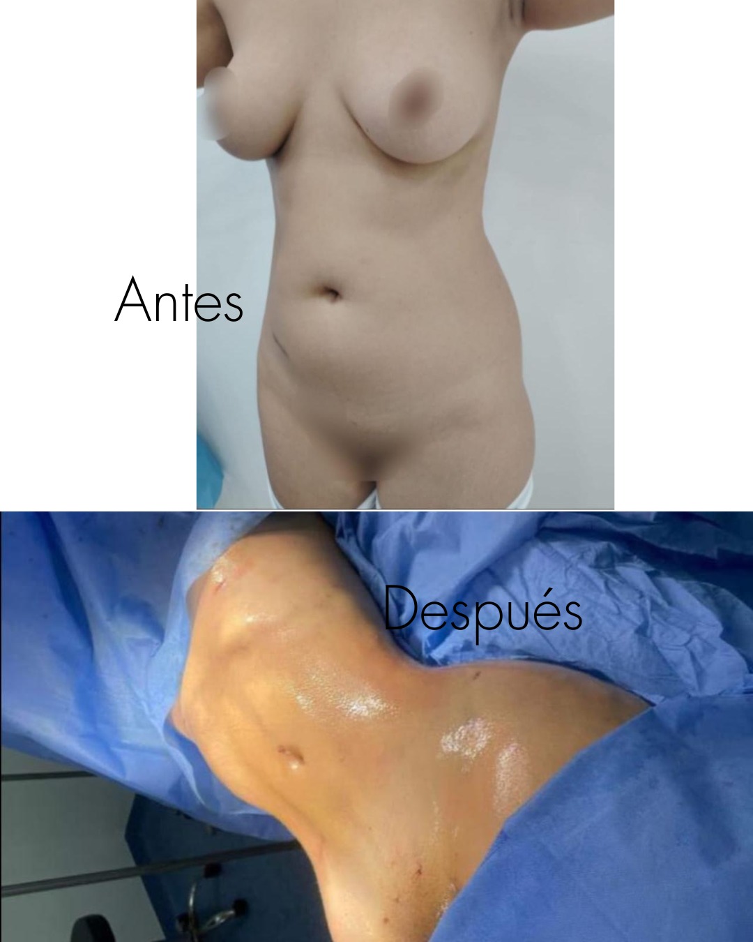 Liposucción en Innova Cirugías Ambato