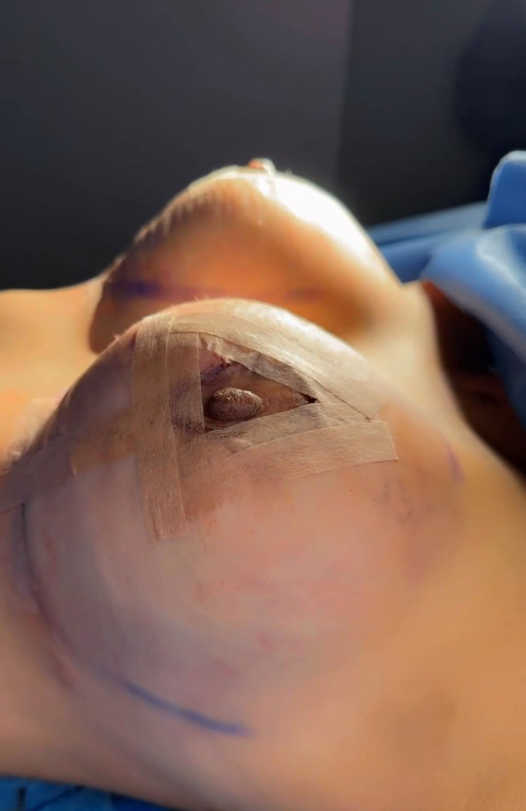 Mastopexia con Implantes en Innova Cirugías Ambato