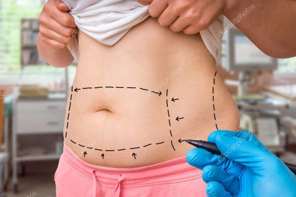 Mini Abdominoplastia en Innova Cirugías Ambato