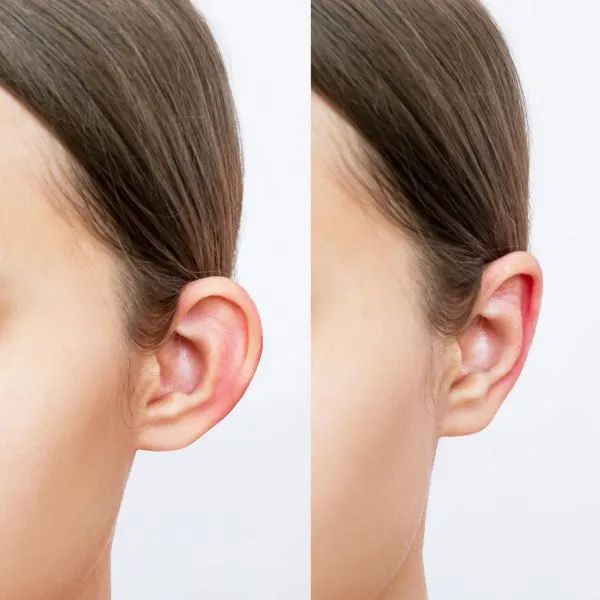 Otoplastia en Innova Cirugías Ambato