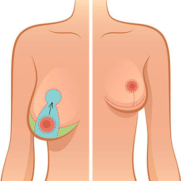 Reducción Mamaria (Mamoplastia de Reducción) en Innova Cirugías Ambato