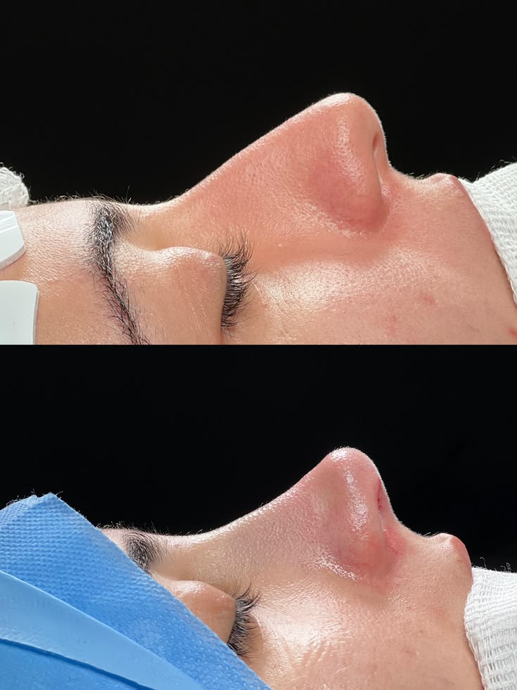 Rinoplastia de Punta (Tip-Plasty) en Innova Cirugías Ambato