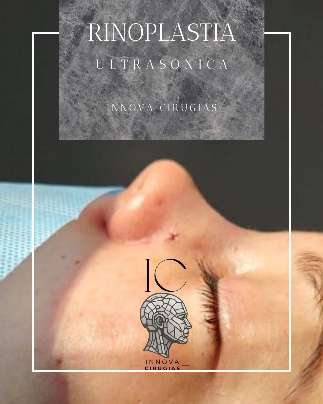 Rinoplastia Ultrasónica en Innova Cirugías Ambato