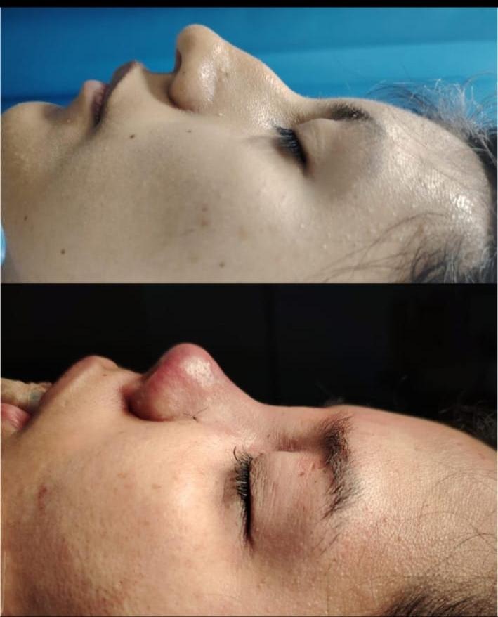 Rinoplastia en Innova Cirugías Ambato