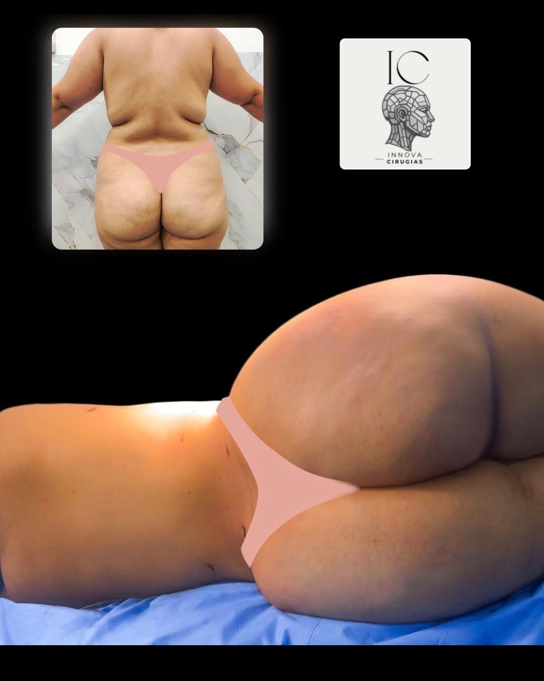 Transferencia de Grasa Autóloga (Lipofilling / BBL Seguro) en Innova Cirugías Ambato